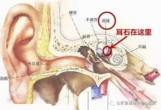 耳石症复位手法视频教程，耳石症的复位方法视频